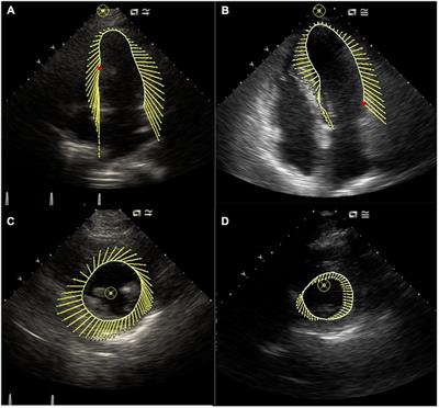 Does types of atrial fibrillation matter in the impairment of global and regional left ventricular mechanics and intra-ventricular dyssynchrony?